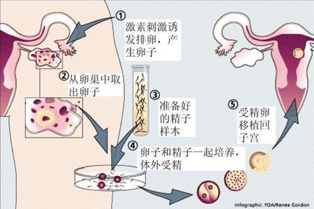 女人代怀试管